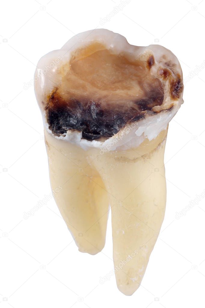 extracted caries tooth isolated on white background close-up macro