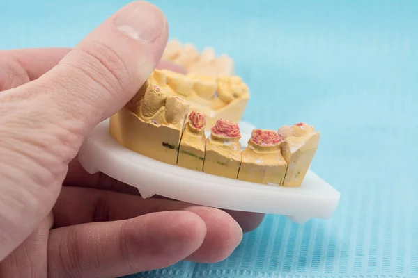 plaster models of the human jaws in the hand of a dental technician in a dental laboratory, manufacturing denture