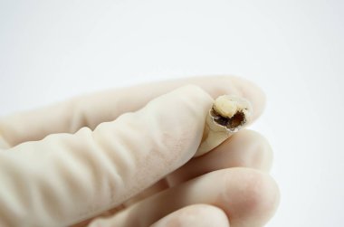 Diş hekiminin elindeki diş macunu beyaz arka planda yakın plan makro, üst bilgelik azı dişi, diş dolgusu parçalanmış.