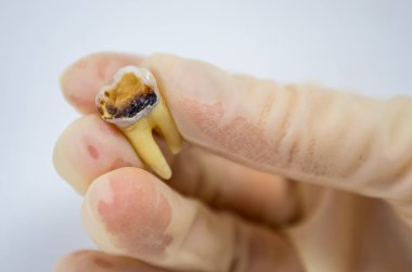 Diş hekiminin elindeki diş macunu beyaz arka planda yakın plan makro, üst bilgelik azı dişi, diş dolgusu parçalanmış.