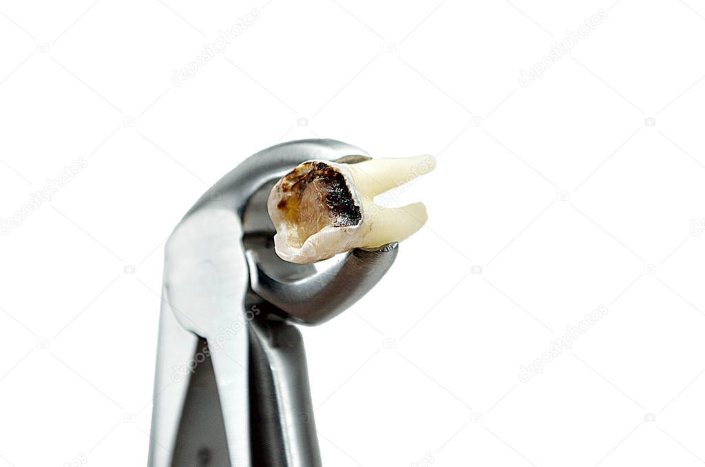 extractive caries tooth in surgical forceps isolated on white background close-up macro, lower wisdom molar, broken tooth filling