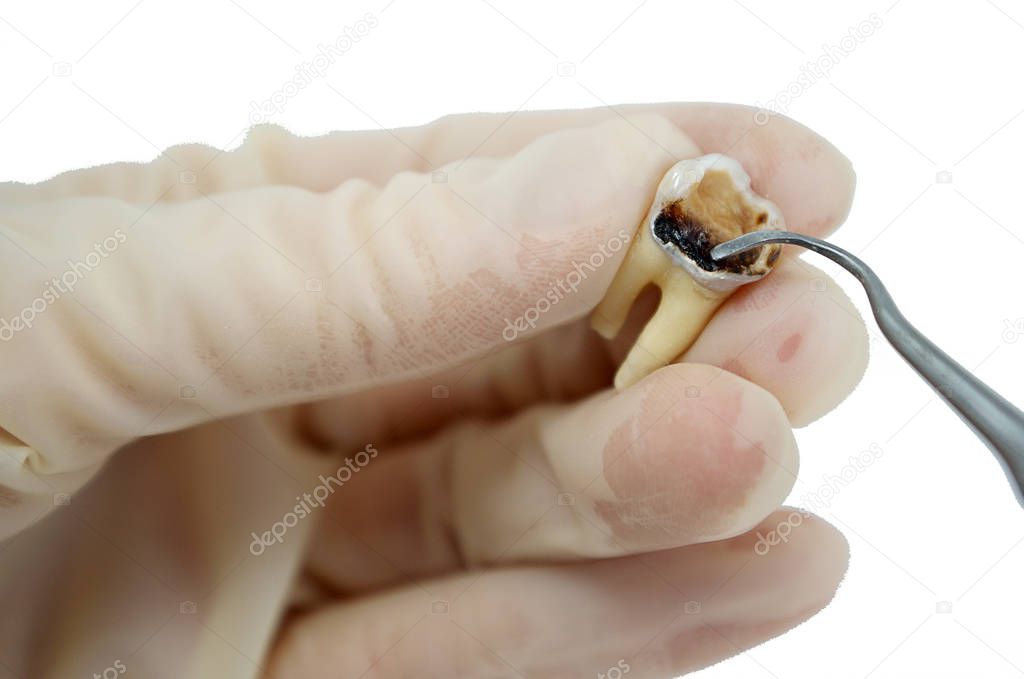 study of the carious cavity of the destroyed caries tooth, close-up macro, isolated