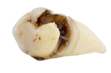 beyaz arka planda izole edilmiş dişler, yakın plan makro, üst bilgelik azı dişi, kırık diş dolgusu