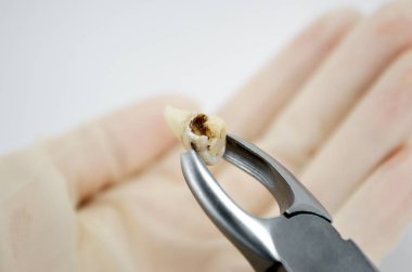 cerrahi forseps içinde diş çıkartır beyaz arka planda yakın plan makro, üst bilgelik azı dişi, tahrip edilmiş diş dolgusu