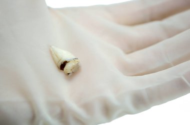 Diş hekiminin elindeki dişleri söküyor beyaz arka planda yakın plan makro, üst bilgelik azı dişi, parçalanmış diş dolgusu, izole edilmiş.