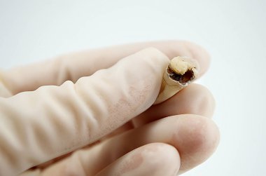 Diş hekiminin elindeki diş macunu beyaz arka planda yakın plan makro, üst bilgelik azı dişi, diş dolgusu parçalanmış.