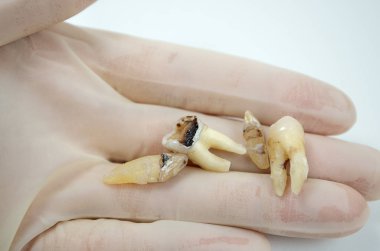 Diş hekiminin elinde diş macunu, beyaz arka planda yakın plan makro, üst ve alt azı dişi bilgeliği, kesici diş, köpek dişi, tahrip edilmiş diş dolgusu.