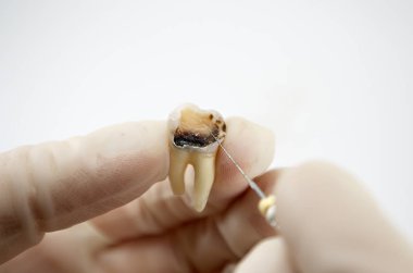 Beyaz arka planda diş tedavisi, yakın plan makro, dişin sinir sökülmesi, endodontik tedavi.