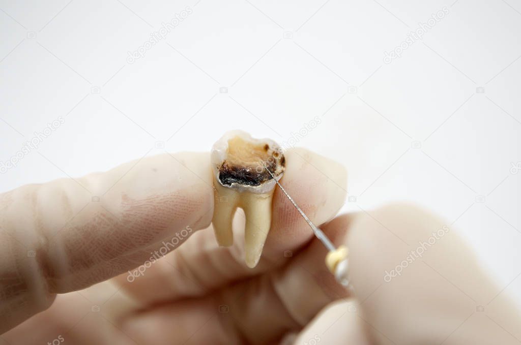 dental treatment on a white background close-up macro, nerve removal from the tooth, endodontic treatment