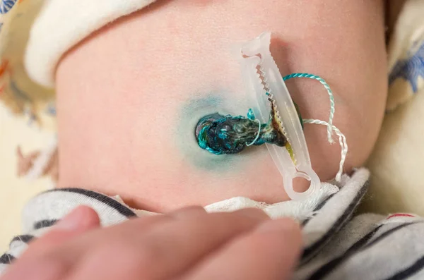 Umbilical Cord Stump Images Libres De Droit Photos De Umbilical Cord Stump Depositphotos Umbilical Cord Stump Images Libres De Droit Photos De Umbilical Cord Stump Depositphotos