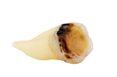 Çıkarılan dişler beyaz arka planda izole edilmiş, yakın plan makro, düşük azı dişi