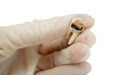 Bir diş hekiminin elindeki diş macunu, beyaz arka planda yakın plan makro, bilgelik azı dişi, tahrip edilmiş diş dolgusu, izole edilmiş.