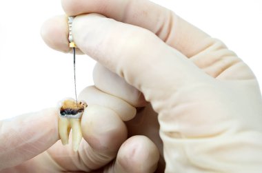 Diş tedavisi beyaz arka planda izole edilmiş, yakın plan makro, dişin sinir sökülmesi, endodontik tedavi