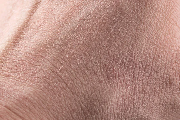 Dry Skin Close Light Background Allergy Skin Peeling Moisturizing — Stock Photo, Image
