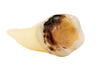 Çıkarılan dişler beyaz arka planda izole edilmiş, yakın plan makro, düşük azı dişi