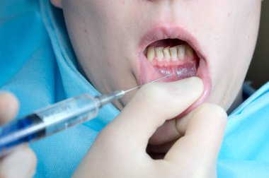 Dişçi koltuğunda diş anestezisi, diş şırıngası, sızma anestezisi, iletken anestezi, dişçide lokal anestezi.