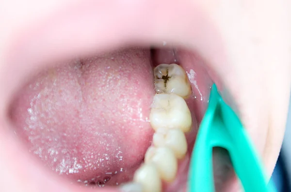 Кариозные Повреждения Зубов Кариес Эстетический Дефект Нарушение Печати — стоковое фото