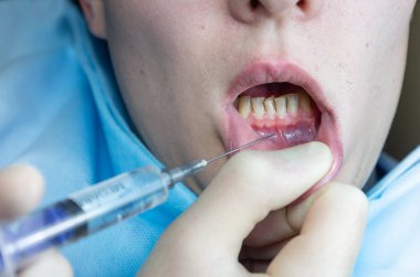 Dişçi koltuğunda diş anestezisi, diş şırıngası, sızma anestezisi, iletken anestezi, dişçide lokal anestezi.