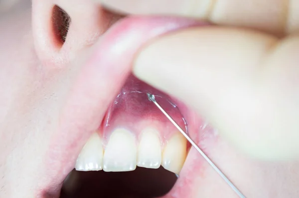 Anestesia Dental Silla Del Dentista Aguja Jeringa Dental Anestesia Infiltración —  Fotos de Stock