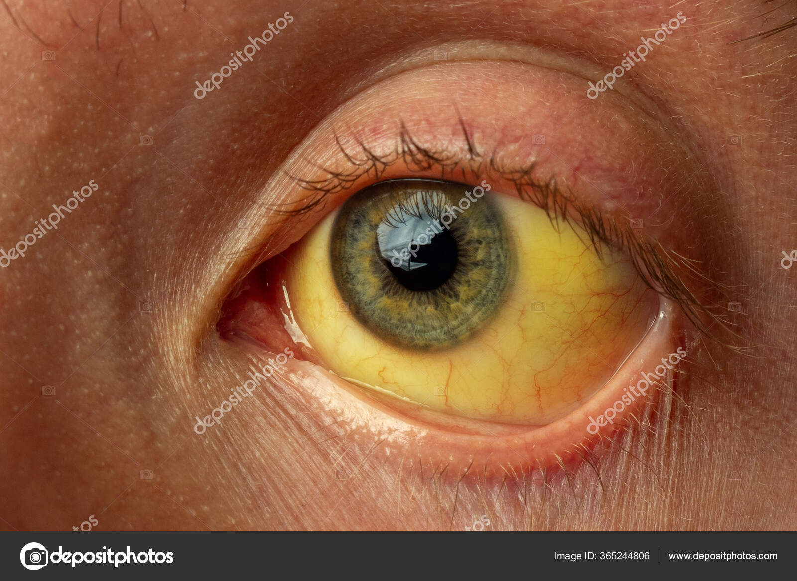 Tinción Amarilla Esclerótica Del Ojo Enfermedades Del Hígado Cirrosis Hepatitis Fotografía De