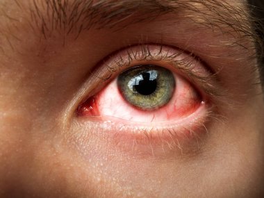 conjunctivitis, conjunctival inflammation, red eyes, infection and inflammation, close up eye clipart