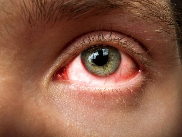 Conjuntivitis Inflamación Conjuntival Ojos Rojos Infección Inflamación Primer Plano Ocular — Foto de Stock