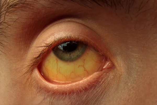 Colorazione Gialla Della Sclera Dell Occhio Malattie Del Fegato Cirrosi — Foto Stock