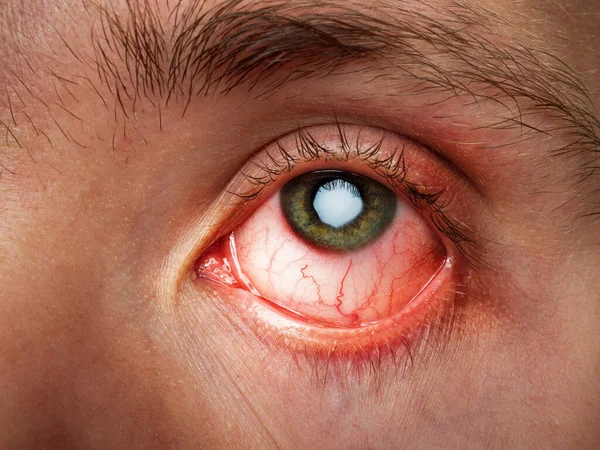 Επιπεφυκίτιδα Φλεγμονή Του Επιπεφυκότα Κόκκινα Μάτια Λοίμωξη Και Φλεγμονή Κοντινό — Φωτογραφία Αρχείου