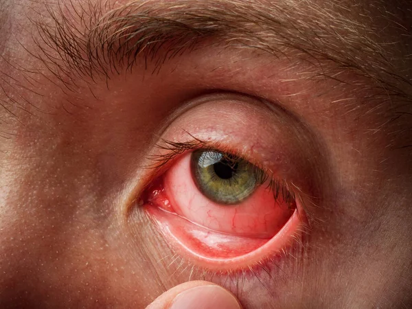 Conjuntivitis Inflamación Conjuntival Ojos Rojos Infección Inflamación Primer Plano Ocular — Foto de Stock