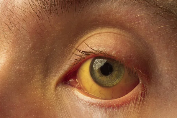 yellow staining of the sclera of the eye in diseases of the liver, cirrhosis, hepatitis, bilirubin