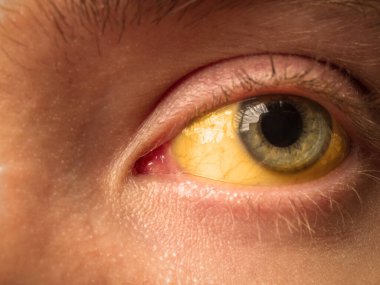 yellow staining of the sclera of the eye in diseases of the liver, cirrhosis, hepatitis, bilirubin clipart