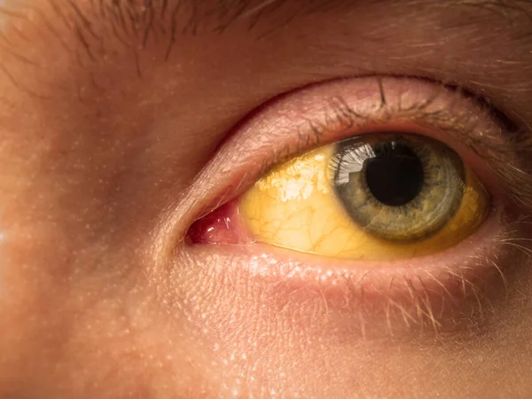 yellow staining of the sclera of the eye in diseases of the liver, cirrhosis, hepatitis, bilirubin