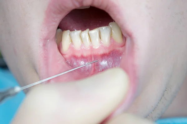 dental anesthesia in the dentist's chair, needle of dental syringe, infiltration anesthesia, conductive anesthesia, local anesthesia in dentistry