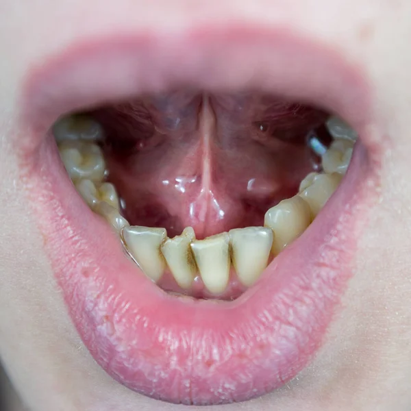 Dents Tordues Sur Mâchoire Inférieure Entassement Des Dents Dans Partie — Photo