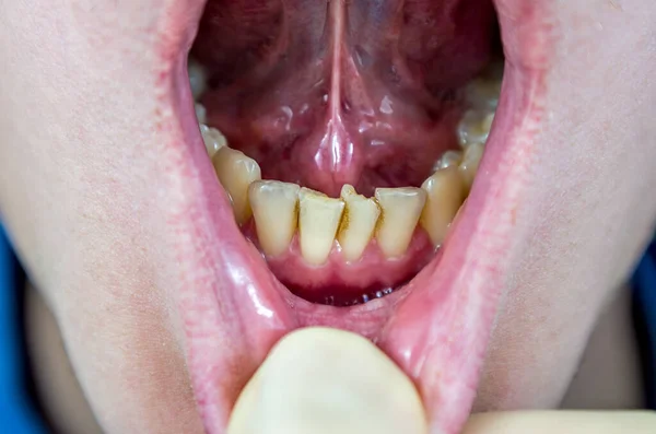 歯列矯正歯科医 曲がった切開部 混雑した歯 口腔衛生不良 歯列矯正の治療の必要性 — ストック写真