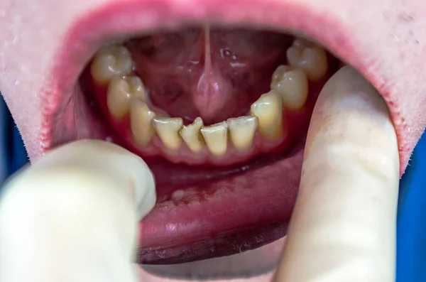 crooked teeth in the anterior part of the patient, at the reception of the orthodontist dentist, crooked incisors, crowded teeth, poor oral hygiene, the need for treatment of braces
