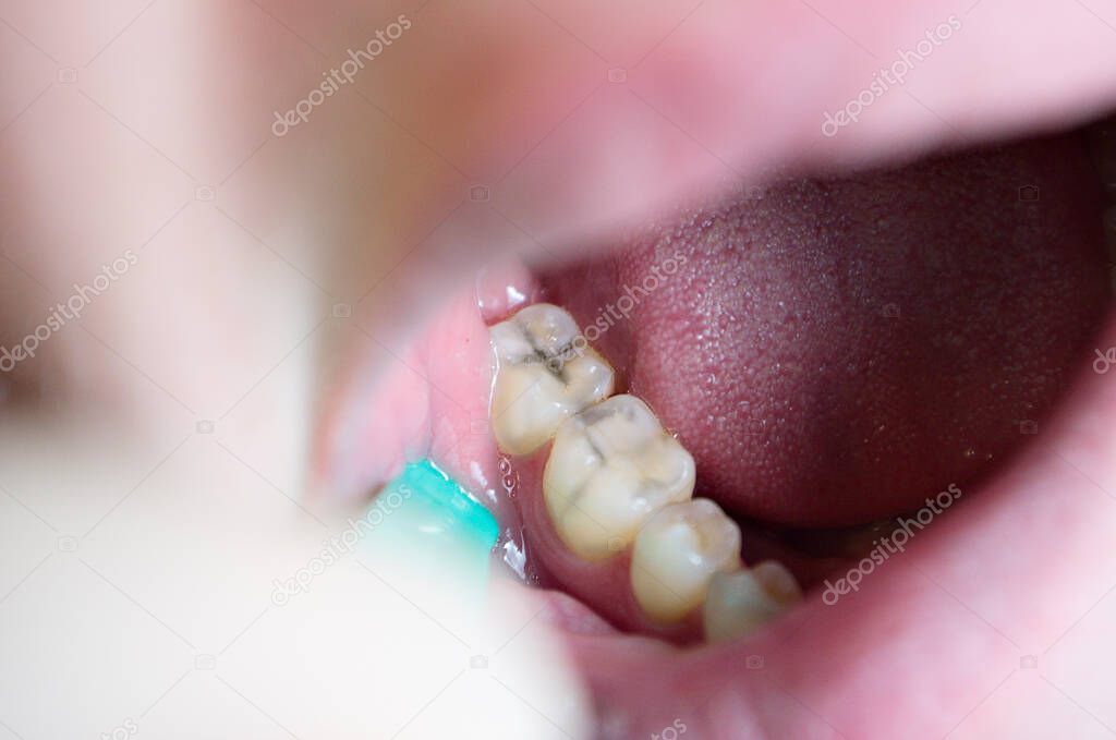 carious lesions on chewing teeth, dental caries, aesthetic defect, violation of the seal