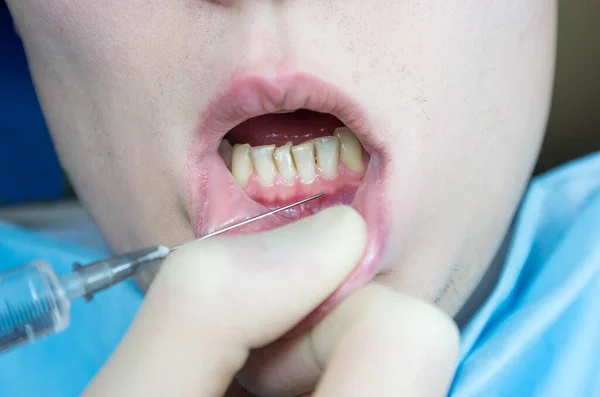 Anestesia Dental Silla Del Dentista Aguja Jeringa Dental Anestesia Infiltración —  Fotos de Stock