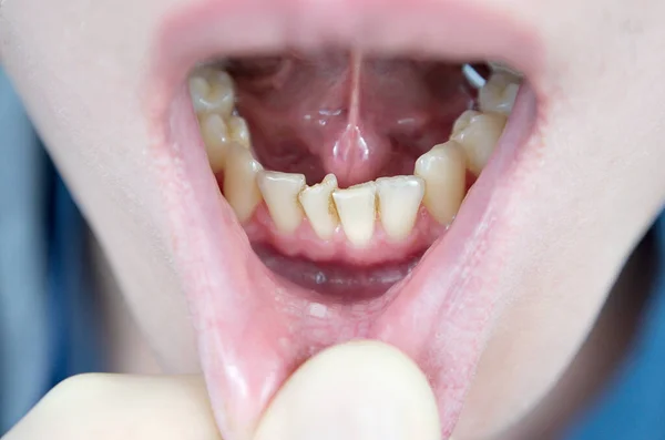 Кривые Зубы Нижней Челюсти Скопление Зубов Передней Части Многолюдные Резцы — стоковое фото