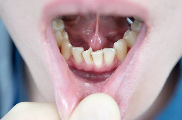 Crooked Teeth Lower Jaw Crowding Teeth Anterior Part Crowded Incisors — ストック写真