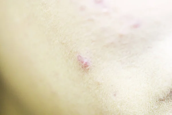 Closeup Inflamação Acne Rosto — Fotografia de Stock