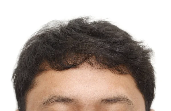 Male head with hair loss symptoms front side, close-up isolated — Stock Photo, Image