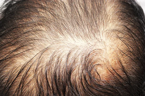 Выпадение волос мужчин, вид сверху — стоковое фото