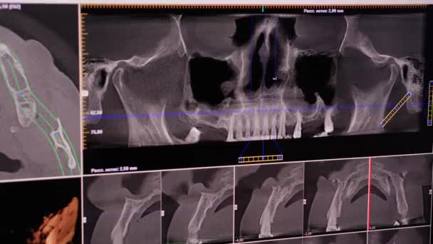 Human head bones and teeth displayed on x-ray photos closeup — 图库视频影像