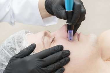 Güzellik salonundaki erkekler için kısmi mikro kaldırma prosedürü