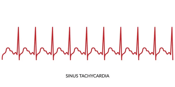 ECG Heartbeat Line. Electrocardiogram vector illustration. Sinus Tachycardia