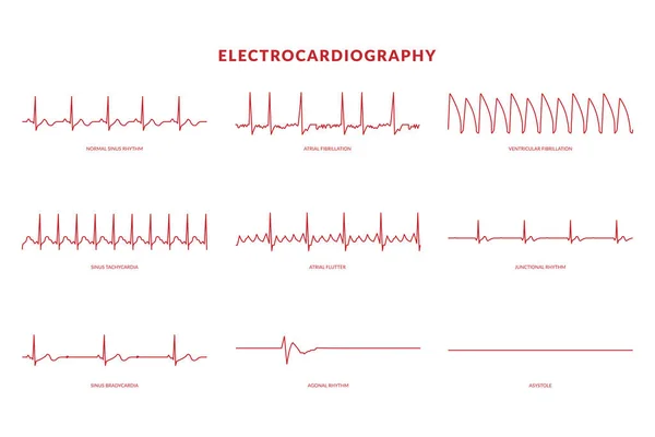 Электрокардиография Монитор Heartbeat Line Векторная Иллюстрация Eps10 — стоковый вектор