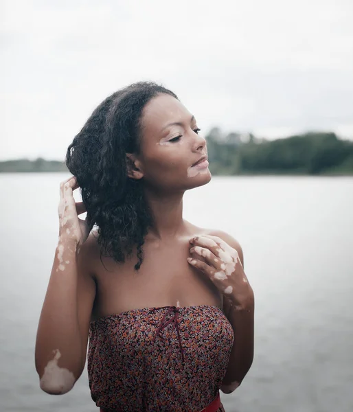 Beautiful young brunette woman with vitiligo disease — Stock Photo, Image