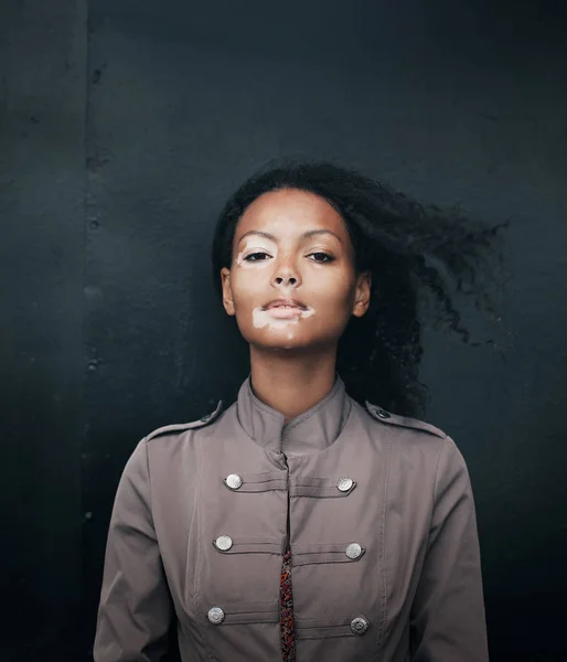 Schöne junge brünette Frau mit Vitiligo-Krankheit — Stockfoto