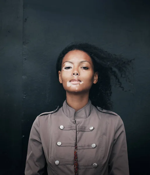 Bela jovem morena mulher com vitiligo doença — Fotografia de Stock